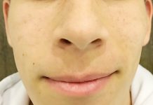 Aknéra hajlamos, de szép bőr? Nem lehetetlen!