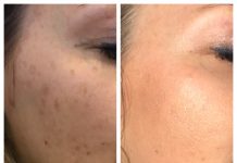 Bőrminőség-javítás Juvederm Volite-tal